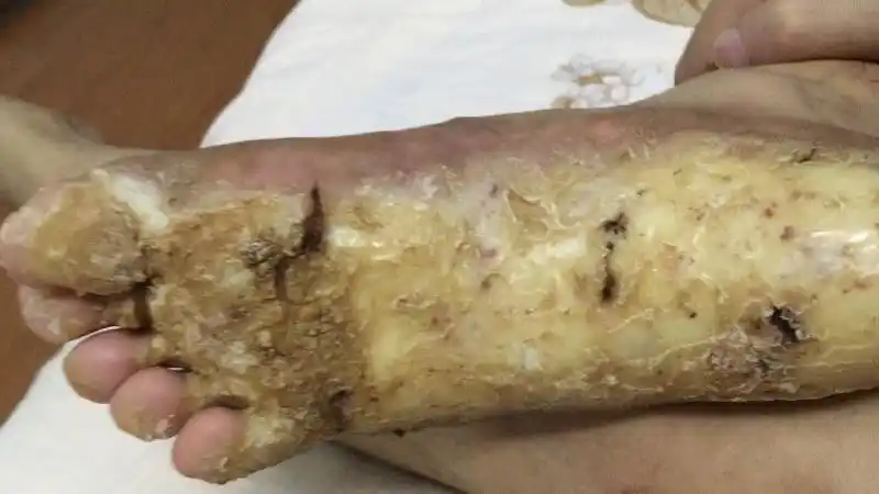 世界罕见皮肤病,寻良医问良药