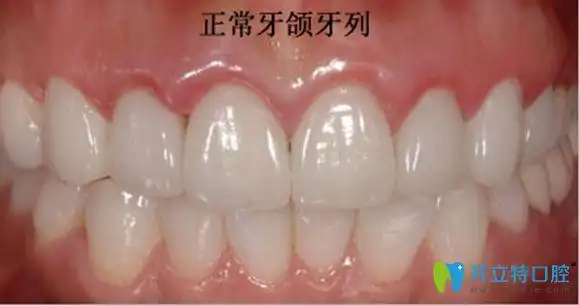 正畸安氏分类诊断标准及牙齿骨性一类二类三类的区别