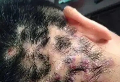 当头皮长出这种小红疙瘩一定要当心了可能是由它引起的