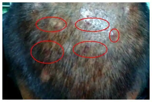 头上出现这些现象说明螨虫已在你的头皮里定居学会方法