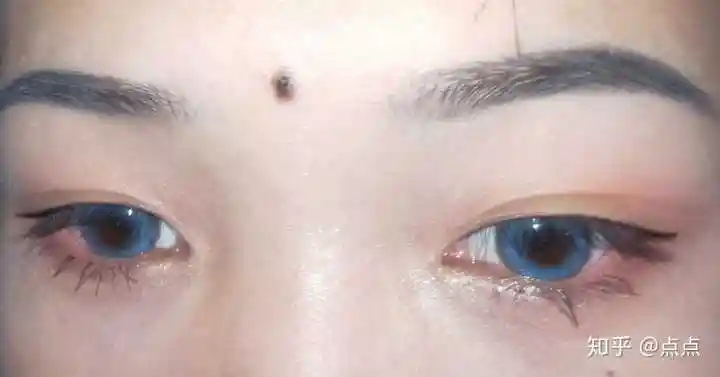 我想知道有多少人长了美人痣啊?