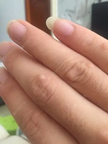 有哪位大师知道这手上长鱼鳞,有么子土方没?