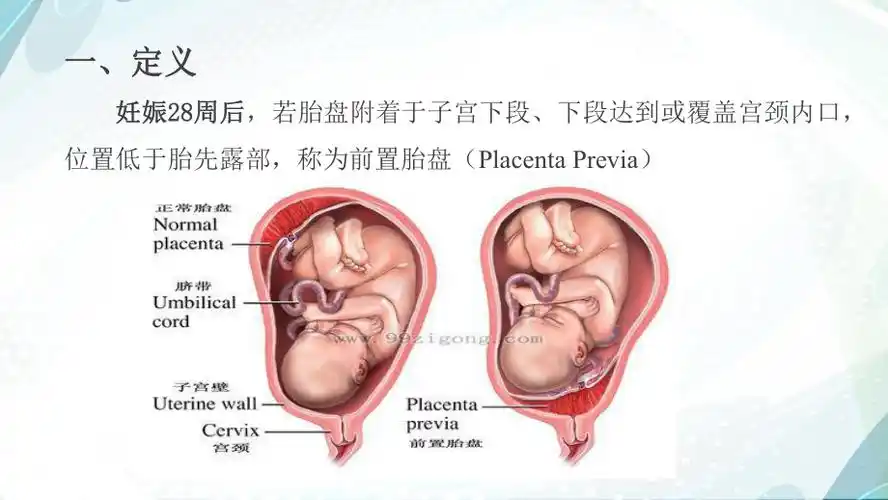 前置胎盘诊疗汇编