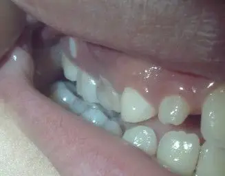 孩子八岁半后槽牙 牙龈上长牙