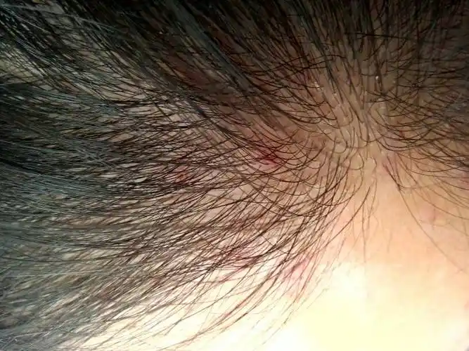 头皮长一个一个的红点是怎么回事?求医生大神!急!_百度知道