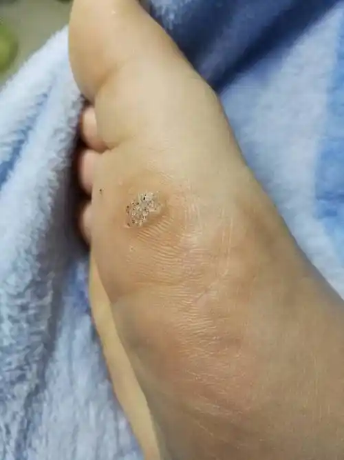 脚上原来扎进了一根刺,一直没拔出来,后来拔出来了就有一个小口,然后