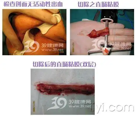 pph痔疮手术中的应用图解希望对大家有帮助