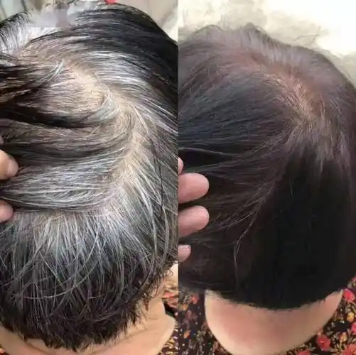 才用了一个月,原本肉眼可见的白色头皮,被新长的头发盖住了,鬓边的