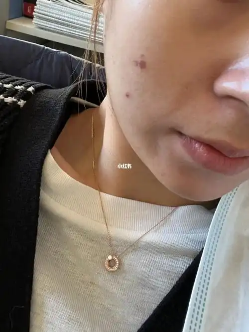 果酸灼伤第三天结痂啦