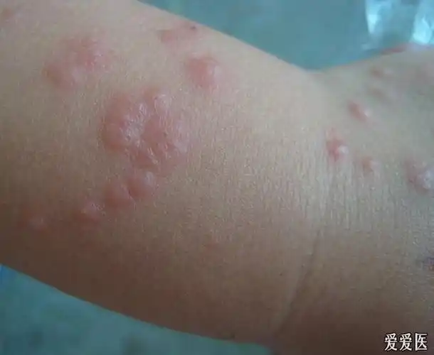 螨虫皮炎治疗前后您来看一看