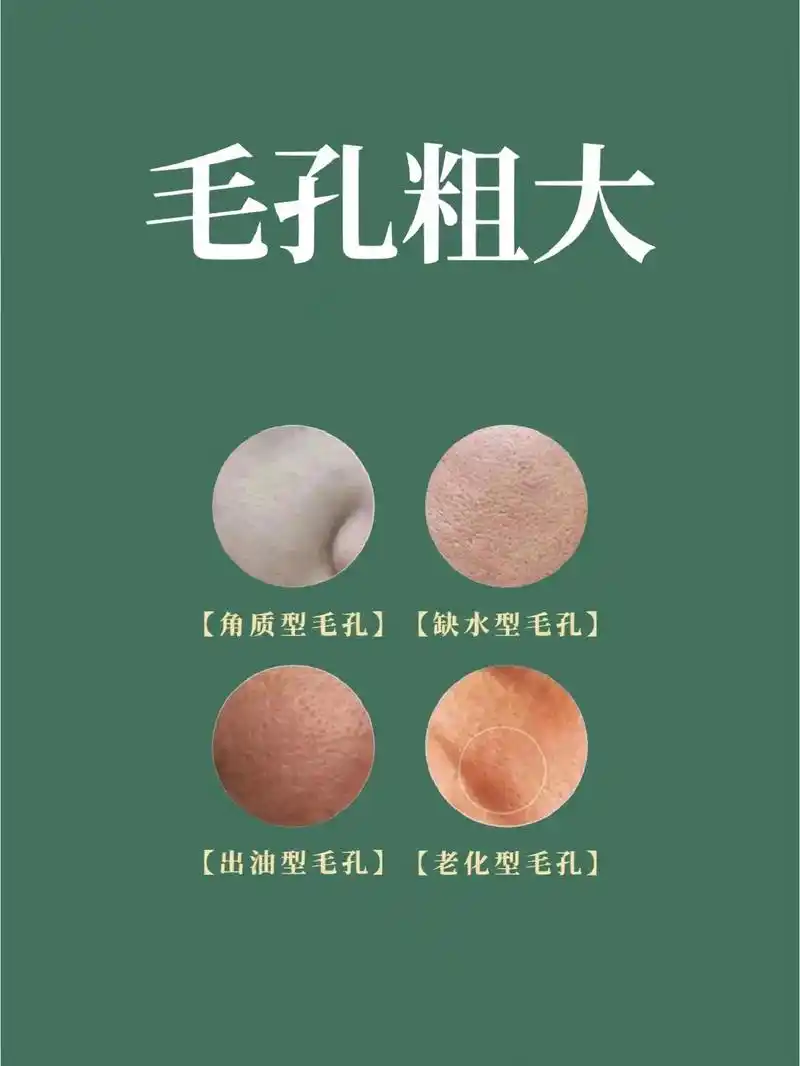 毛孔粗大0269♀15.