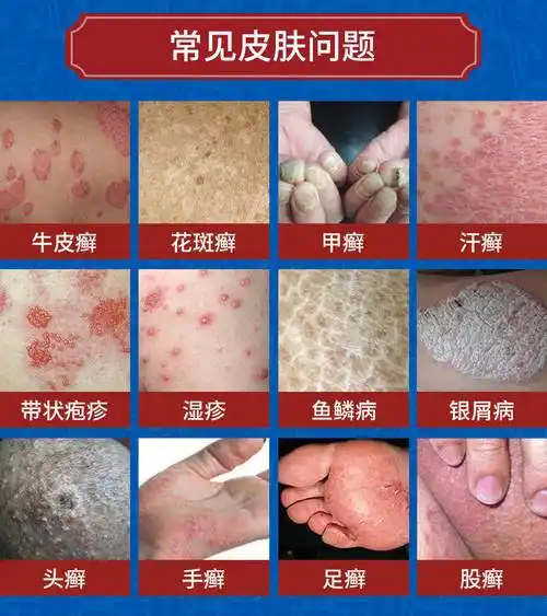 苏宁专营苗药湿疹牛皮癣药膏股癣过敏顽固皮肤瘙痒皮炎头癣软膏手足癣