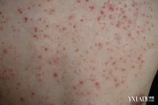 图得了毛囊炎容易治吗4个治疗方法帮你解决问题