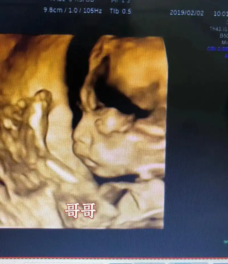 久违的四维彩超图片,不管男女,只希望你健康.又是个高鼻梁宝宝 - 抖音