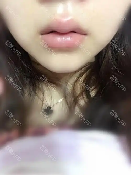 看看嘟嘟唇的效果,第一张是刚打好回到家拍的,后_圈子-新氧美容整形