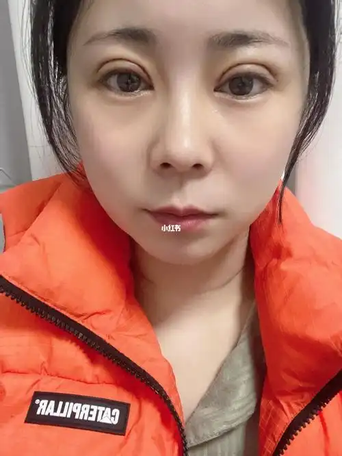 全切双眼皮第七天_全切双眼皮_双眼皮手术_美妆_医美整形