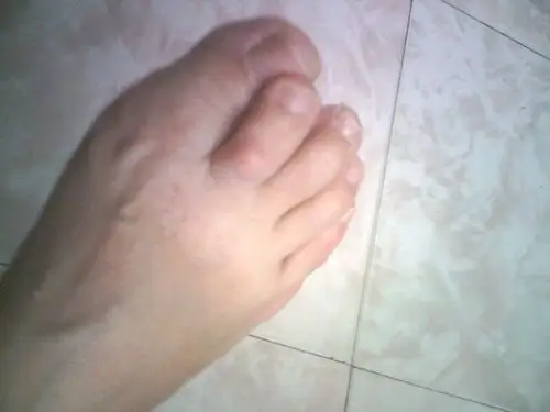 我妈45岁一只脚的第二个脚趾上翘,压到第一个上边,刚开始不明显,现在