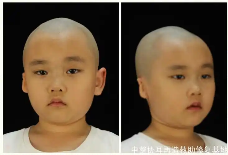 小耳畸形手术效果