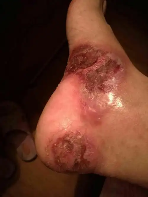 脚上皮肤溃烂病例分享