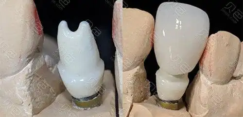 种植牙基台是什么材料?为什么有的是白色有的是金属色?