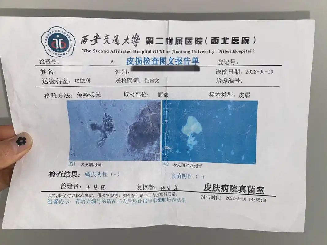 皮肤镜检测 真菌检测 过敏原检测 做过检查的报告单,如果你的症状跟我