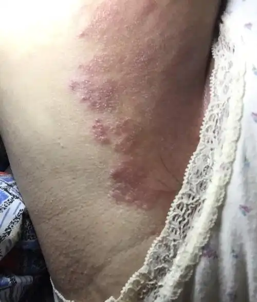 你好林医生我大腿内侧根部得了股藓擦了药但是一直不见好