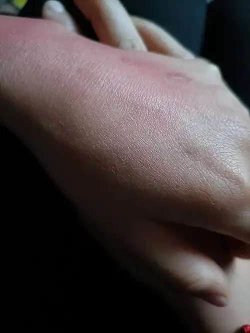 手被开水烫到,好疼.