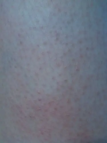 请问大腿上长了是湿疹吗有时痒有时不痒可以涂什么药