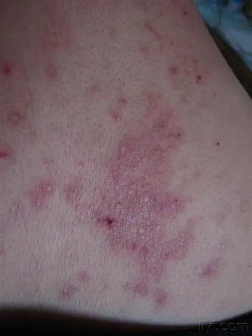 女患者的颈背部神经性皮炎