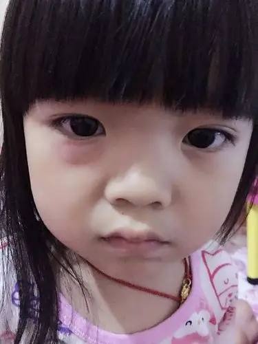 宝宝三周岁,昨晚右眼下睫毛下方有一块像蚊子咬了一样的包包,开始以为