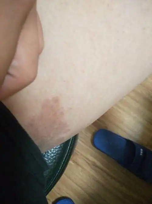 我的大腿内侧一大块红黑红黑的,有时候痒有时候不痒,这是什么病啊
