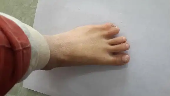 并趾手术不宜迟_先天性足畸形_症状_手术_症状表现_治疗方式 - 好大夫