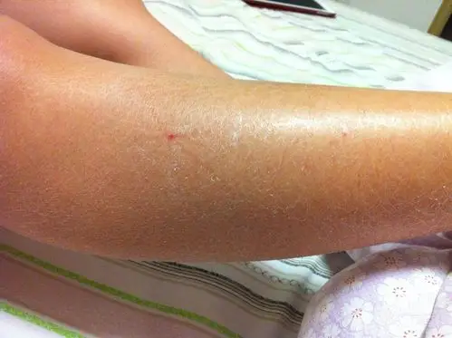 【请教】皮肤角质化 [病例帖]